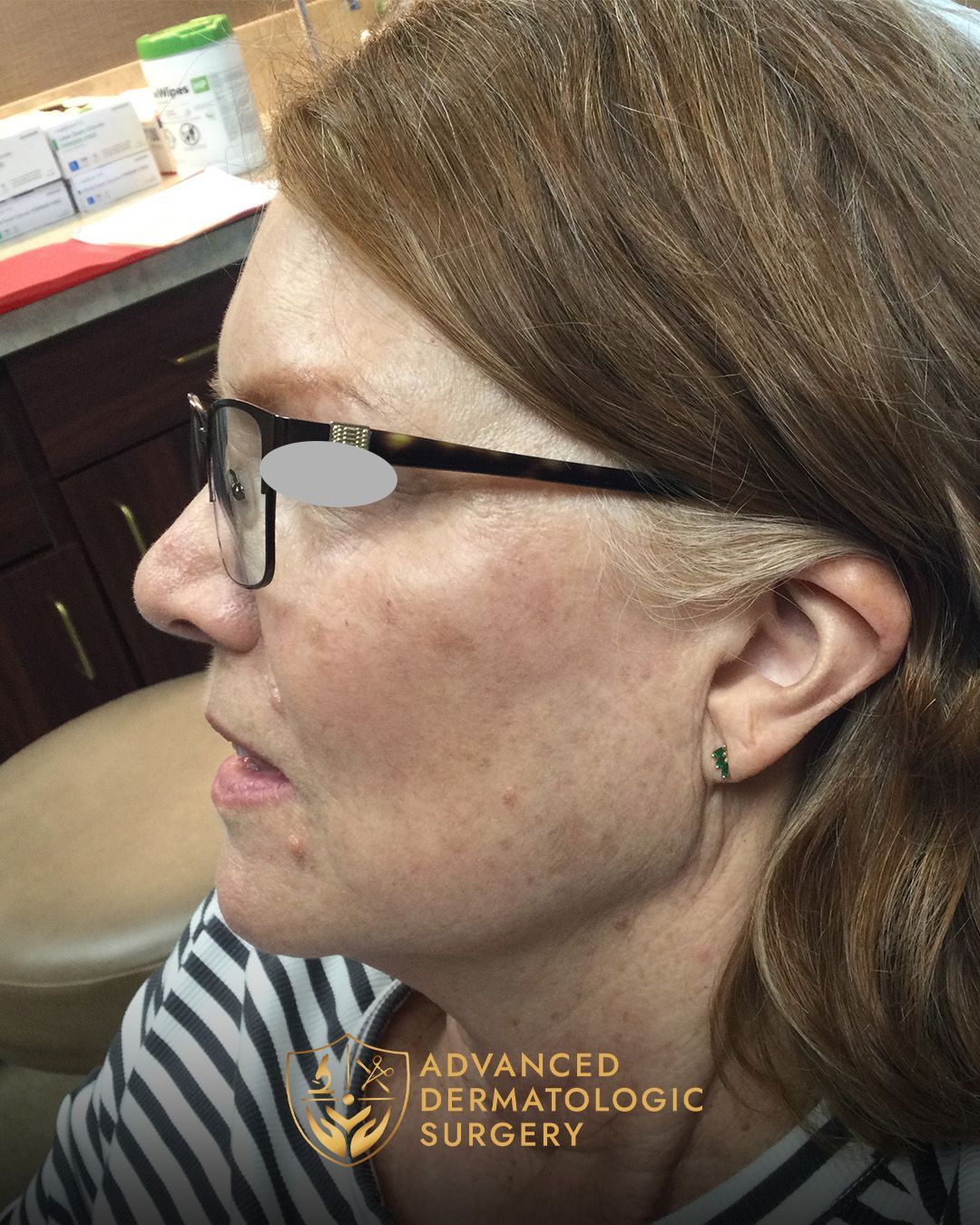 A fully healed cheek of a woman that went through reconstruction surgery at Advanced Dermatologic Surgery