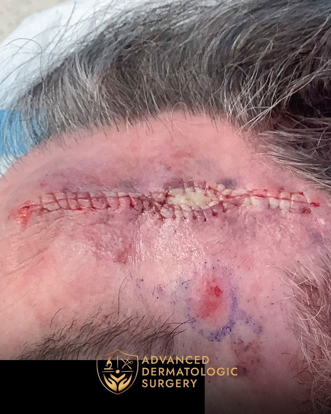 Close up of reconstruction surgery on a forehead