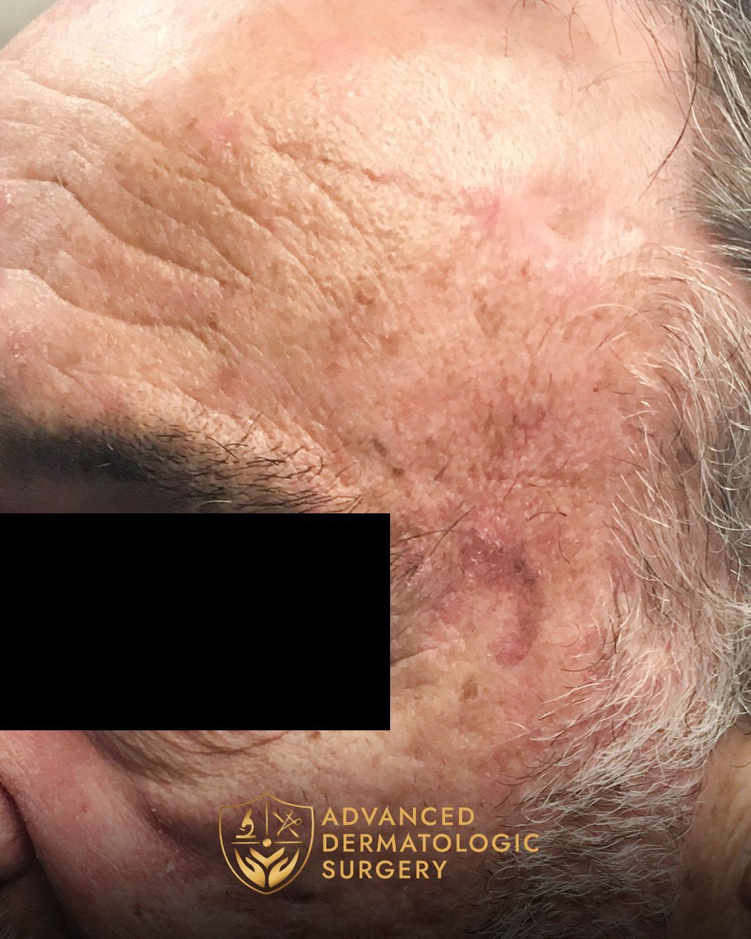 Close up of a fully healed forehead after sugery