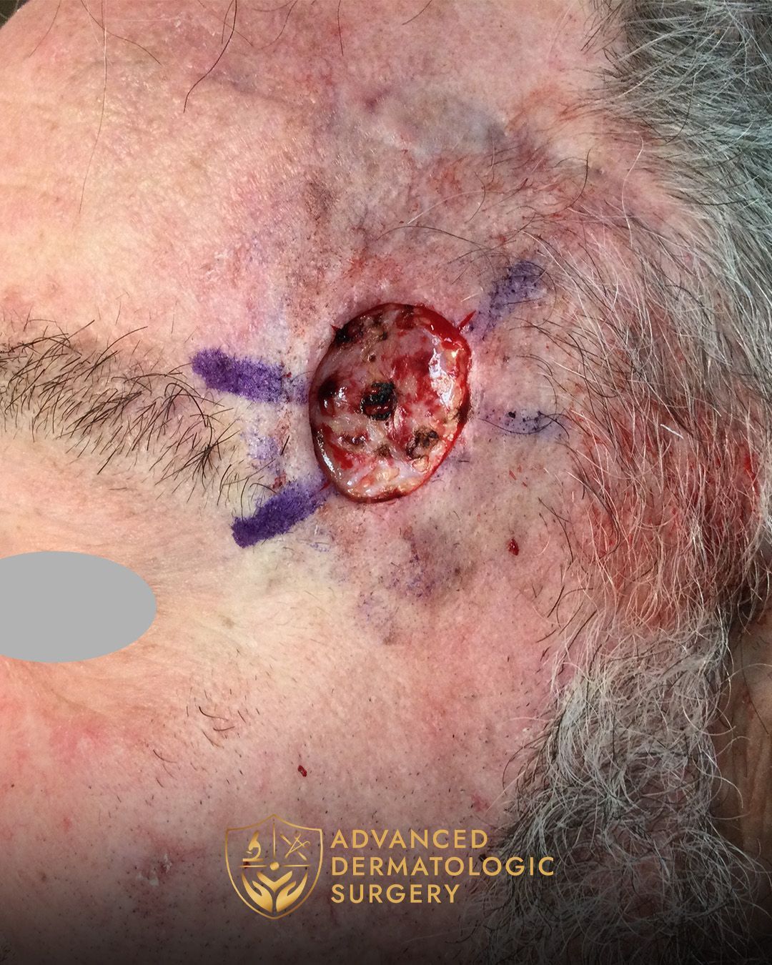 Close up of a man's temple who had a spot removed for MOHS