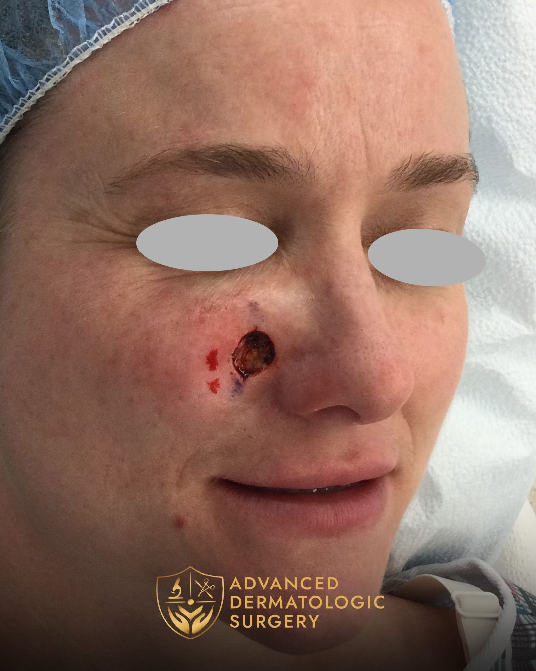 Close up of a woman's face who received a MOHS surgery on her cheek at Advanced Dermatologic Surgery