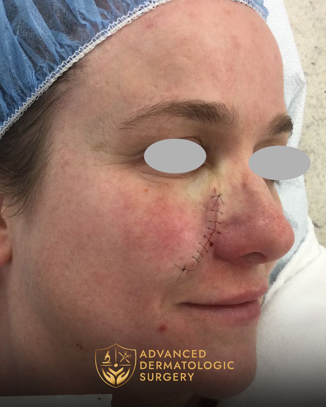 Close up of a young woman's cheek after reconstruction at Advanced Dermatologic Surgery