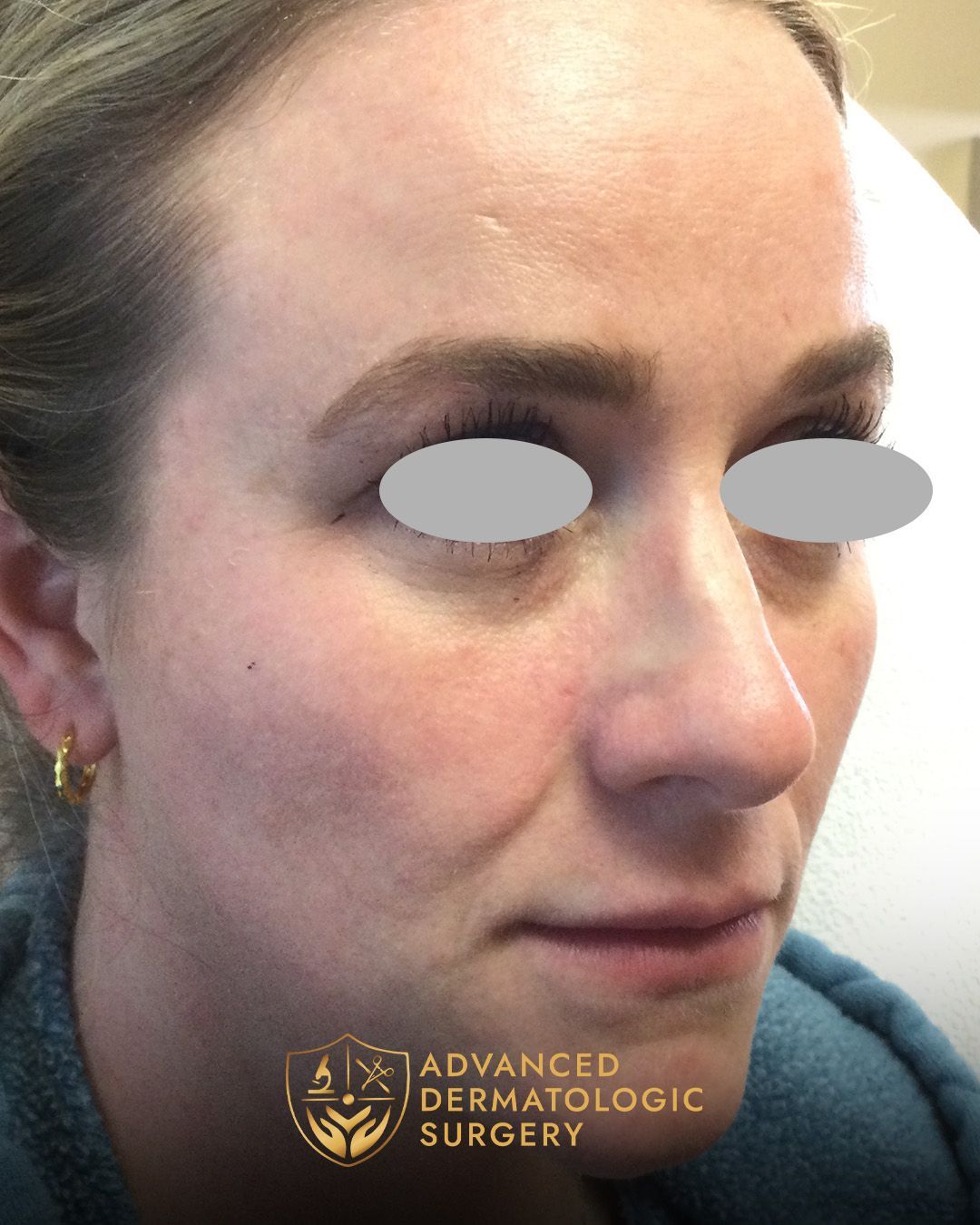 A fully healed cheek of a woman that went through reconstruction surgery at Advanced Dermatologic Surgery