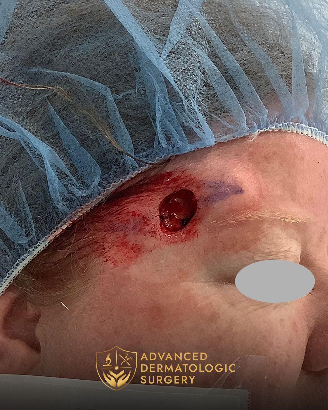 Close up of a MOHS surgery spot on a woman's right temple