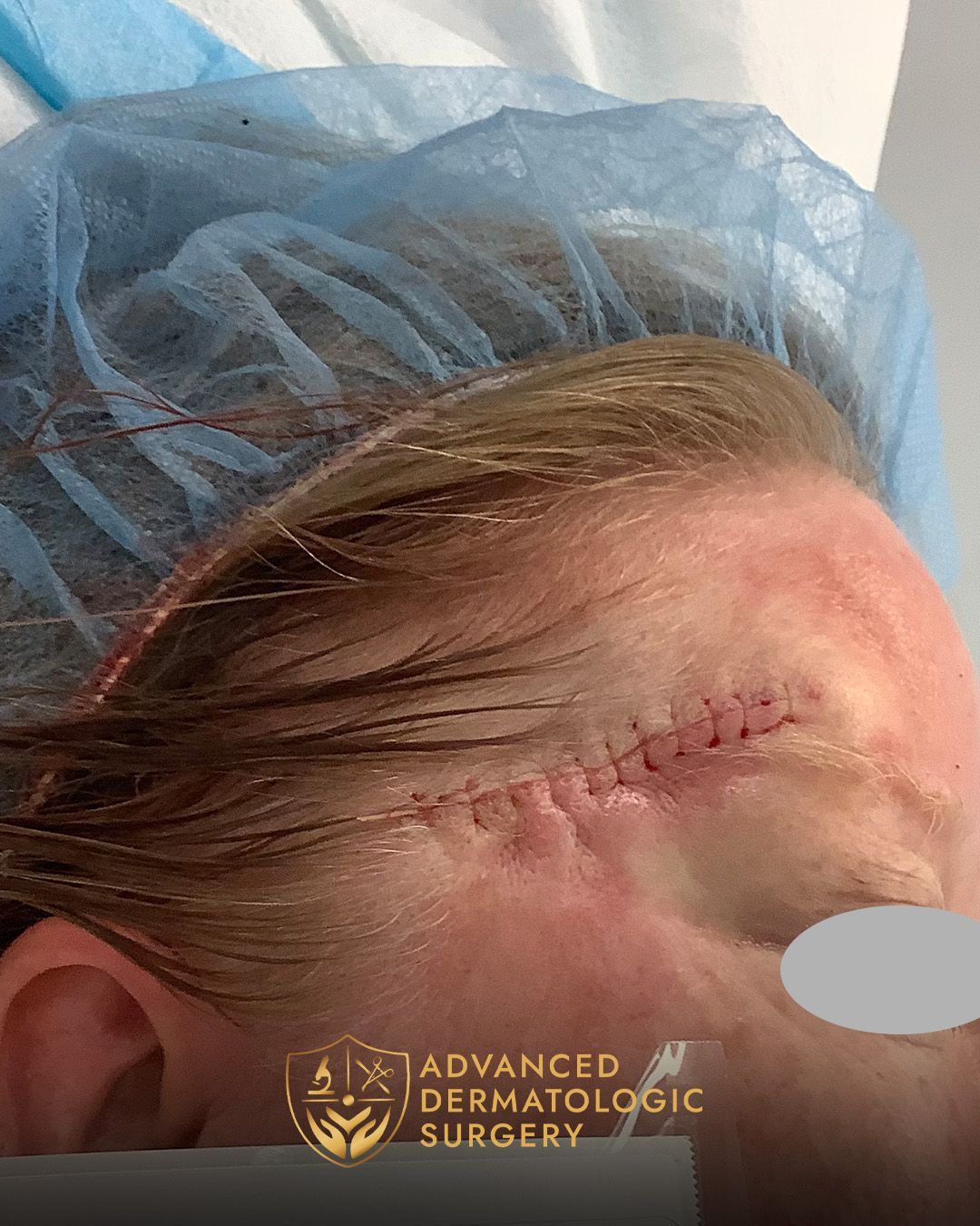 Close up of a temple after reconstruction surgery on a woman's right temple