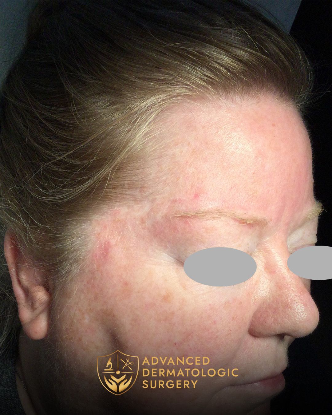 Fully healed temple of a woman who underwent MOHS surgery 