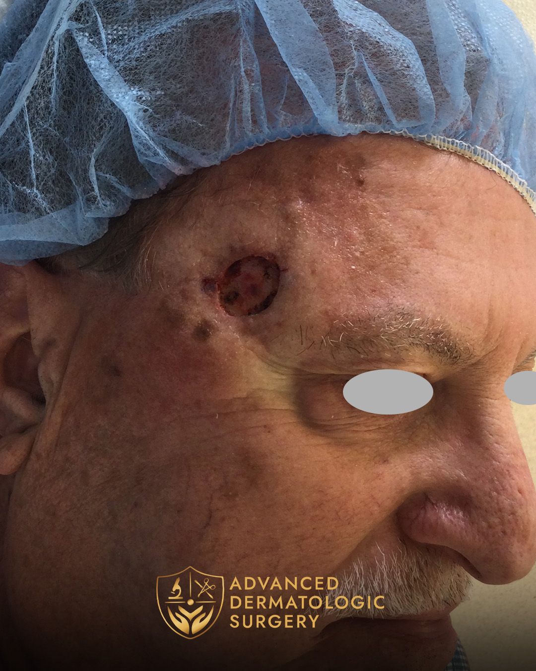 Close up of a man's temple who had a spot removed for MOHS