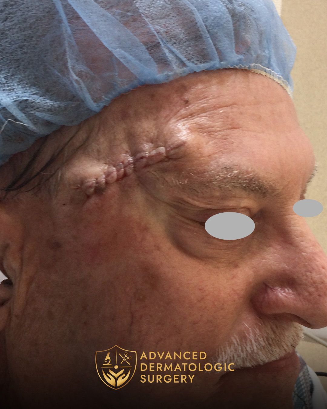 Close up of a man's temple after reconstruction surgery