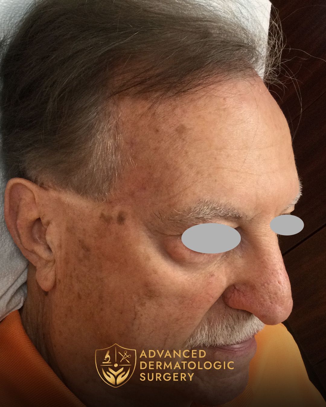 Fully healed temple of a man who underwent MOHS surgery