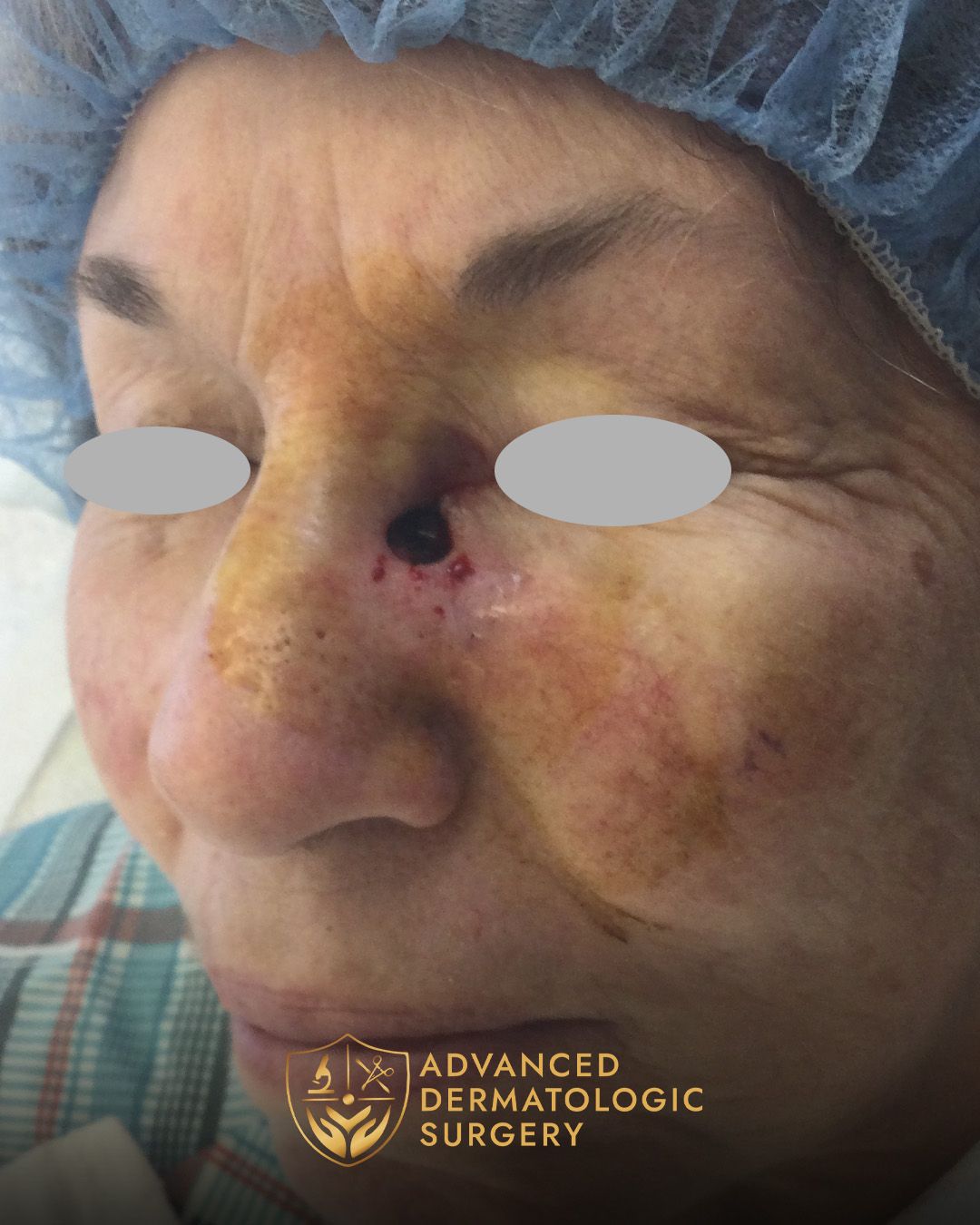 Side view of a woman's nose after Mohs surgery