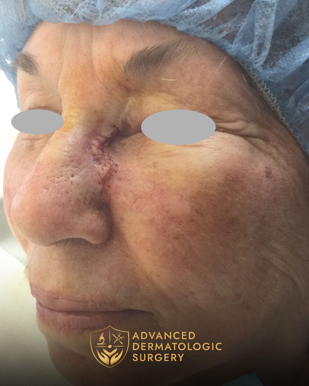 Side view of a woman's nose after reconstruction surgery