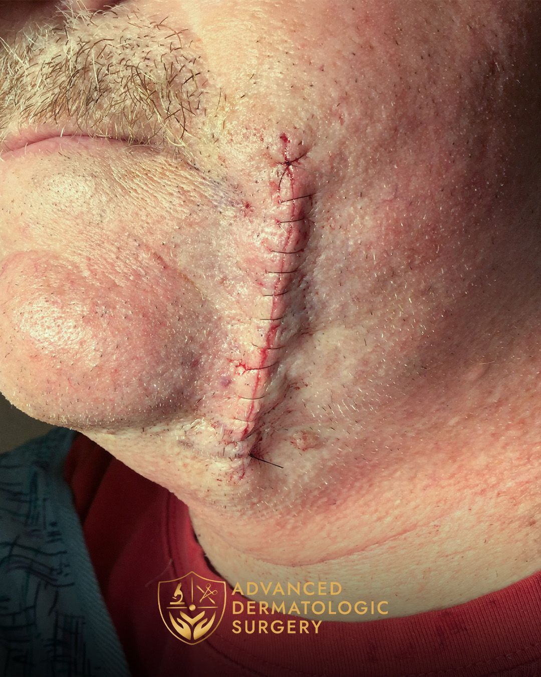 Close up of a mans jawline after reconstruction surgery
