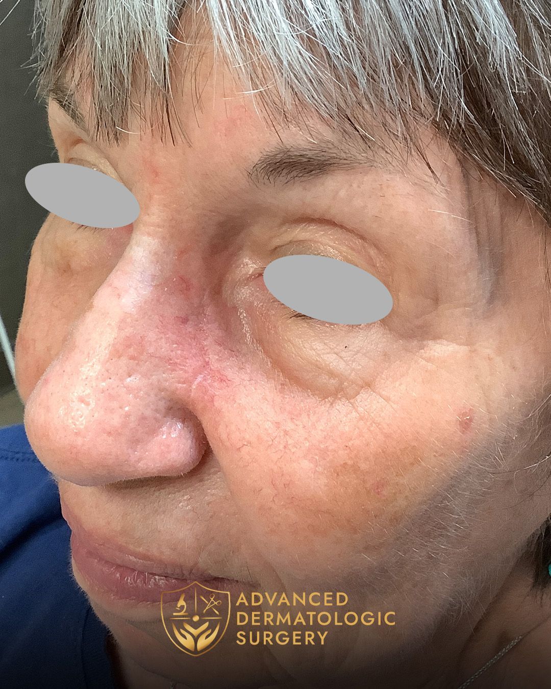 Side view of a woman's nose after fully healing