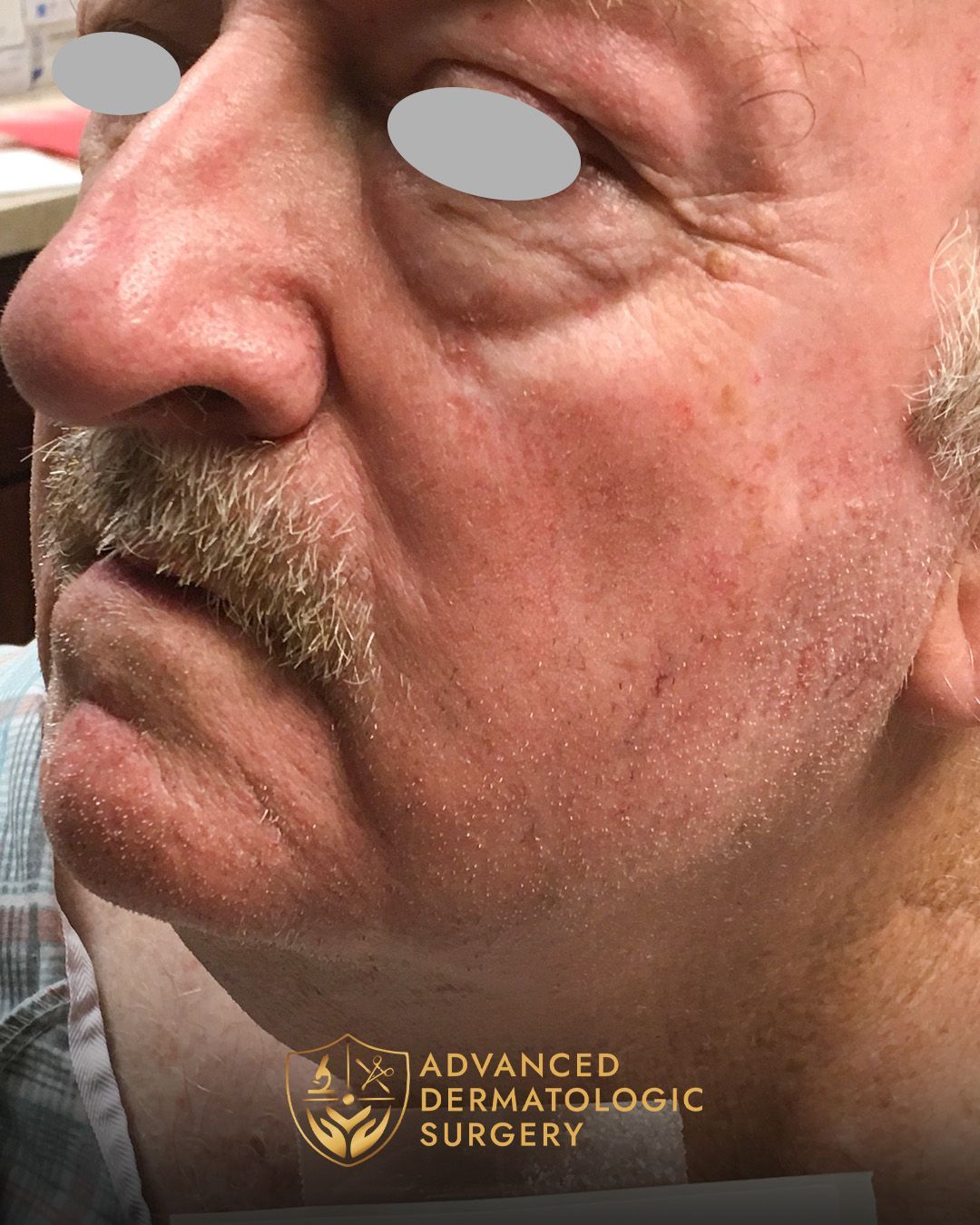 Close up of a fully healed jawline