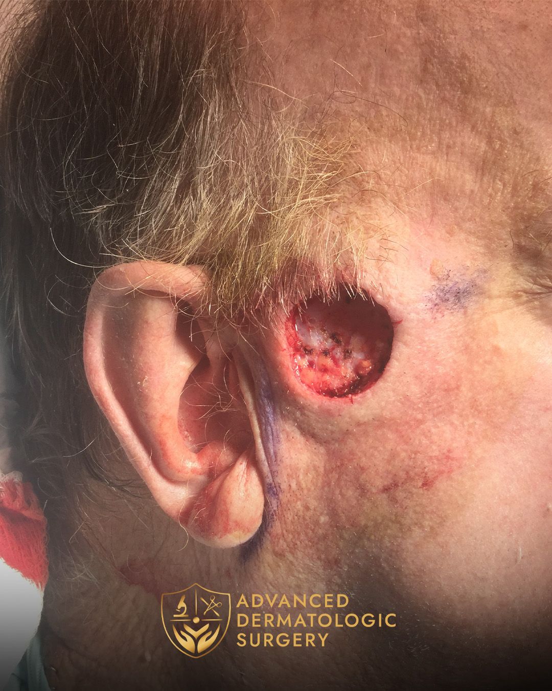 Close up of a MOHS surgery spot on a man's right temple