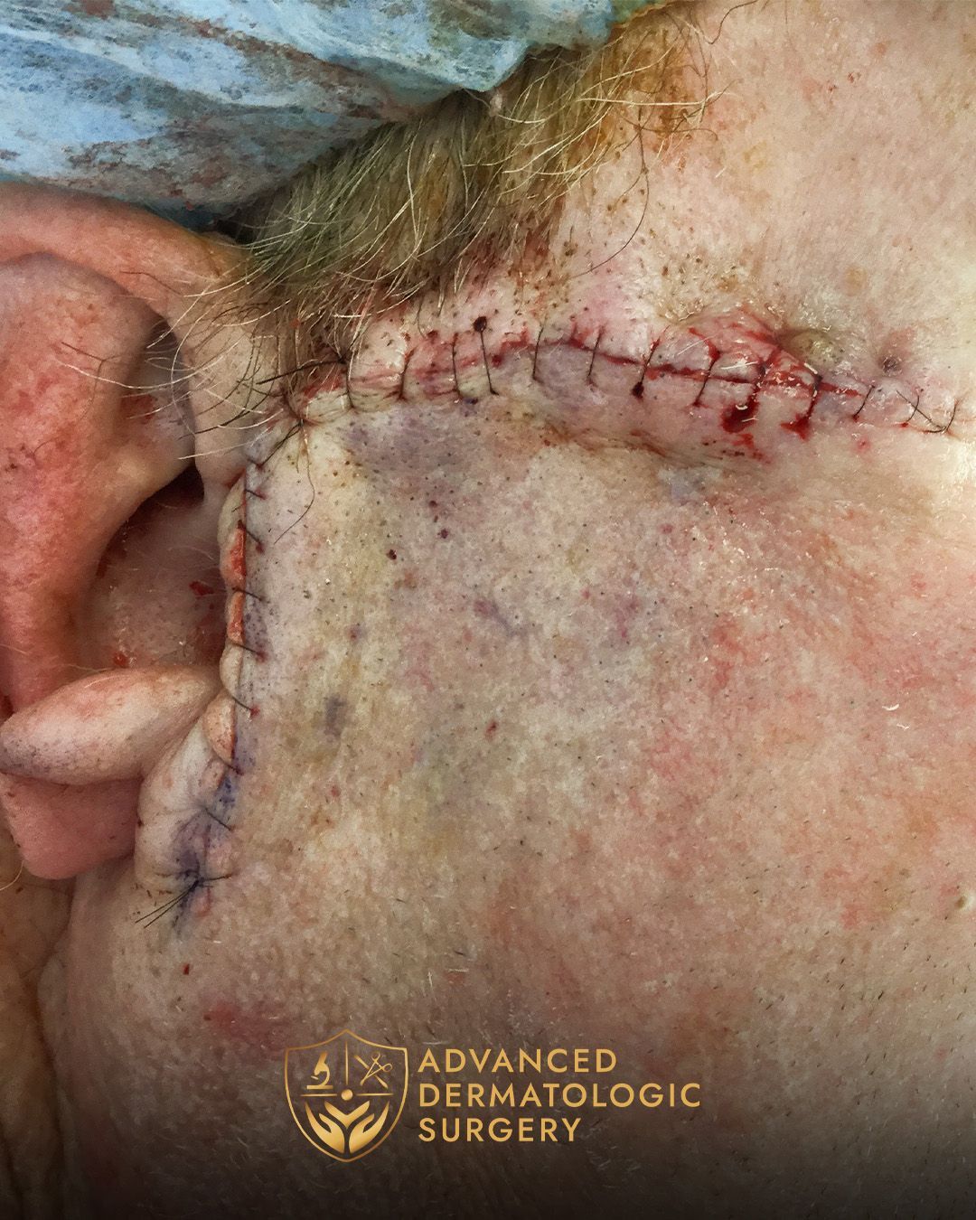 Close up of a temple after reconstruction surgery on a man's right temple