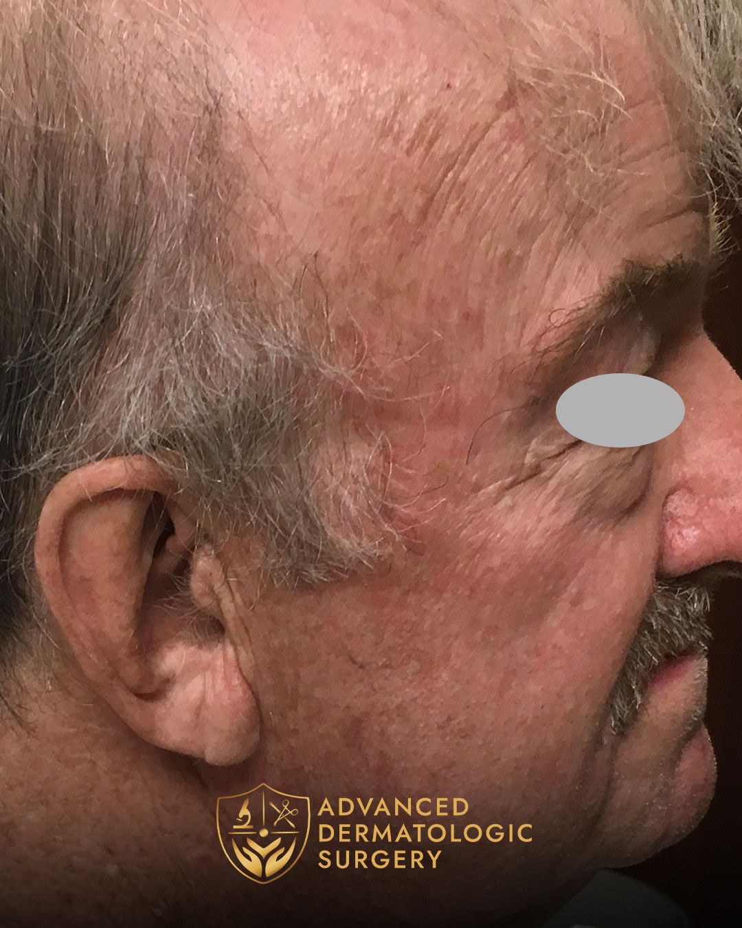 Fully healed temple of a man who underwent MOHS surgery 