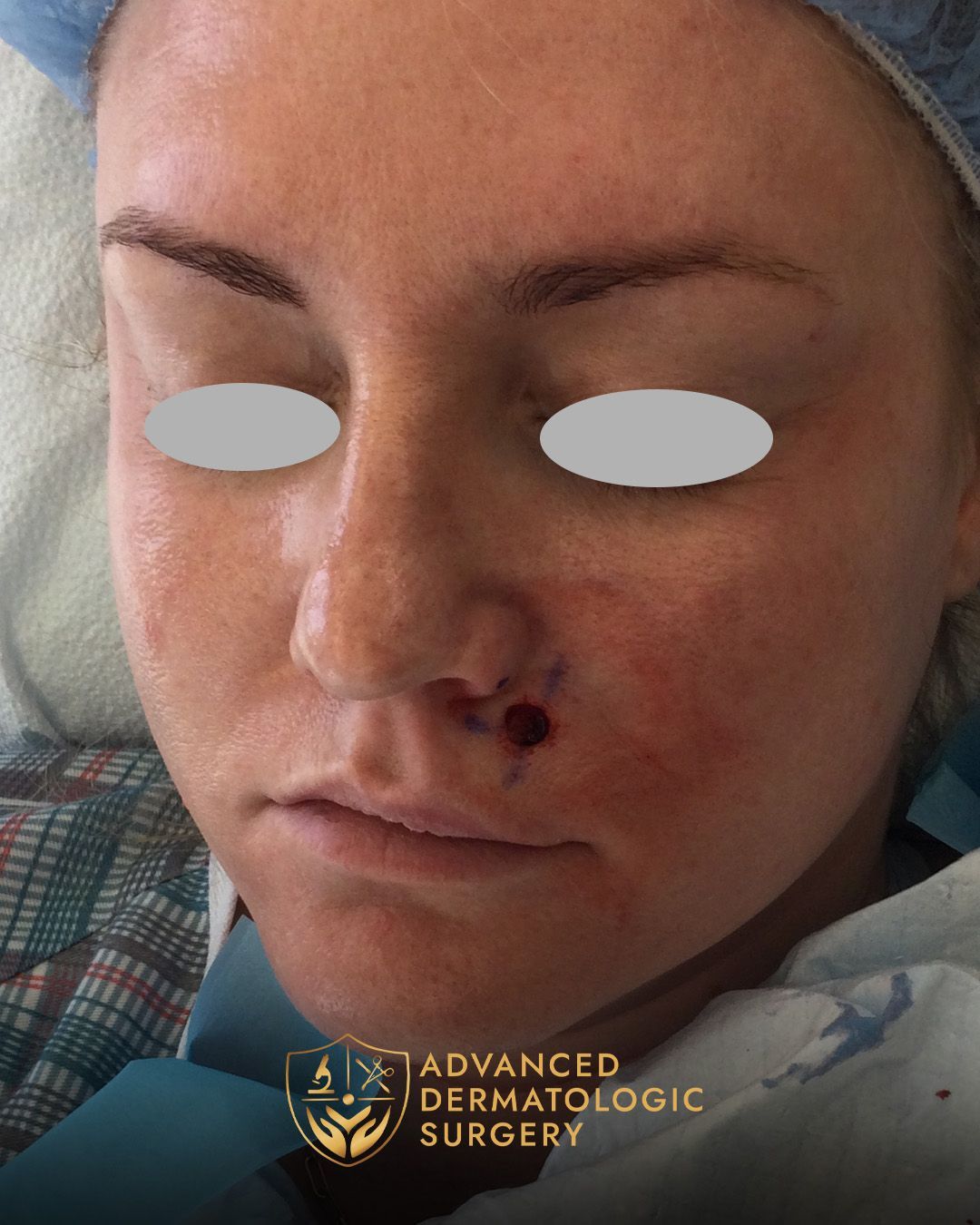 Close up of a woman's face who received a MOHS surgery on her cheek at Advanced Dermatologic Surgery