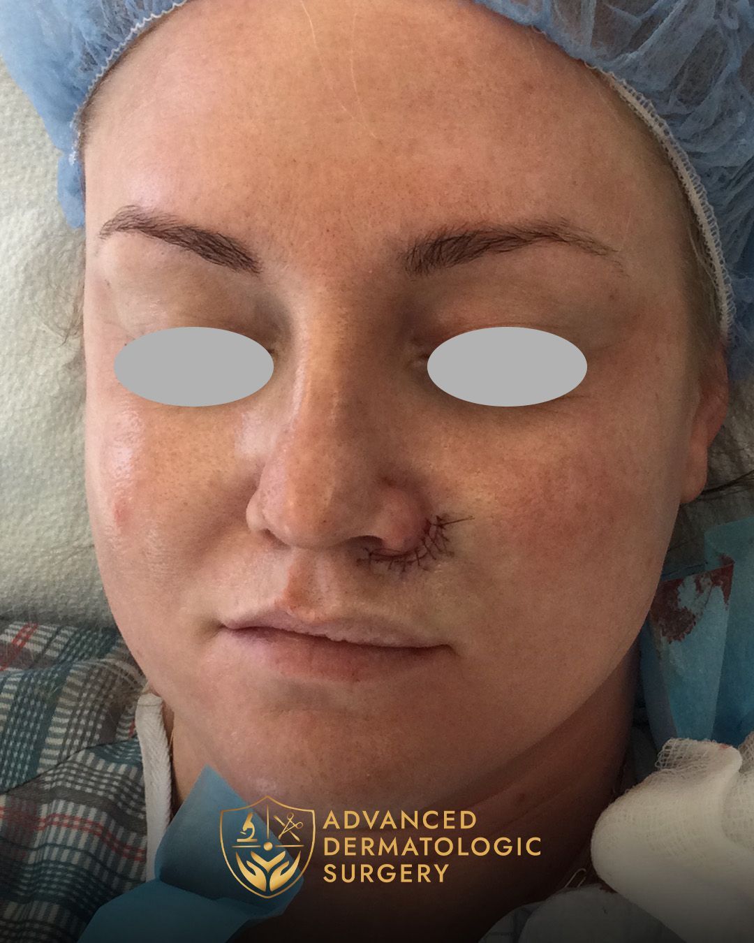 Close up of a young woman's cheek after reconstruction at Advanced Dermatologic Surgery