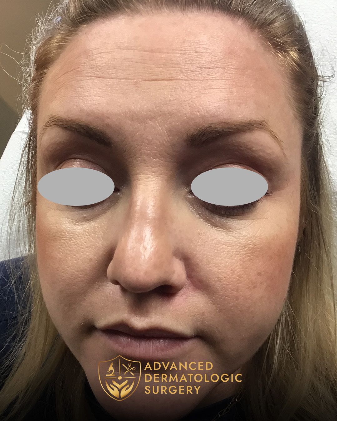 A fully healed cheek of a woman that went through reconstruction surgery at Advanced Dermatologic Surgery