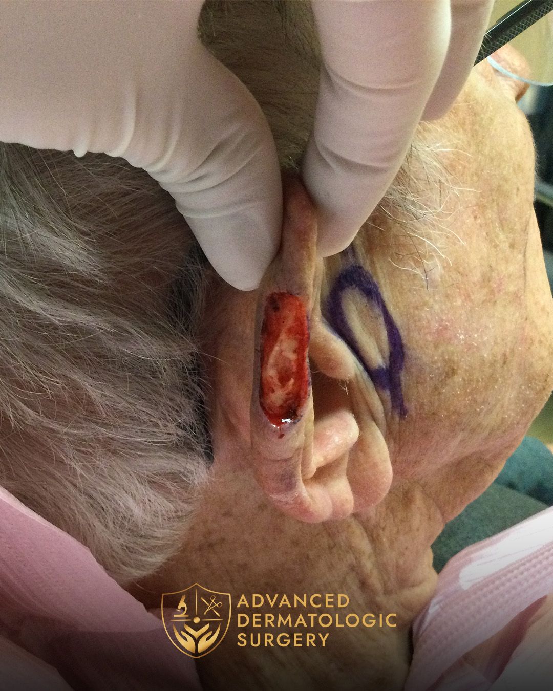 Close up of a spot Mohs removal by a man's ear done at Advanced Dermatologic Surgery