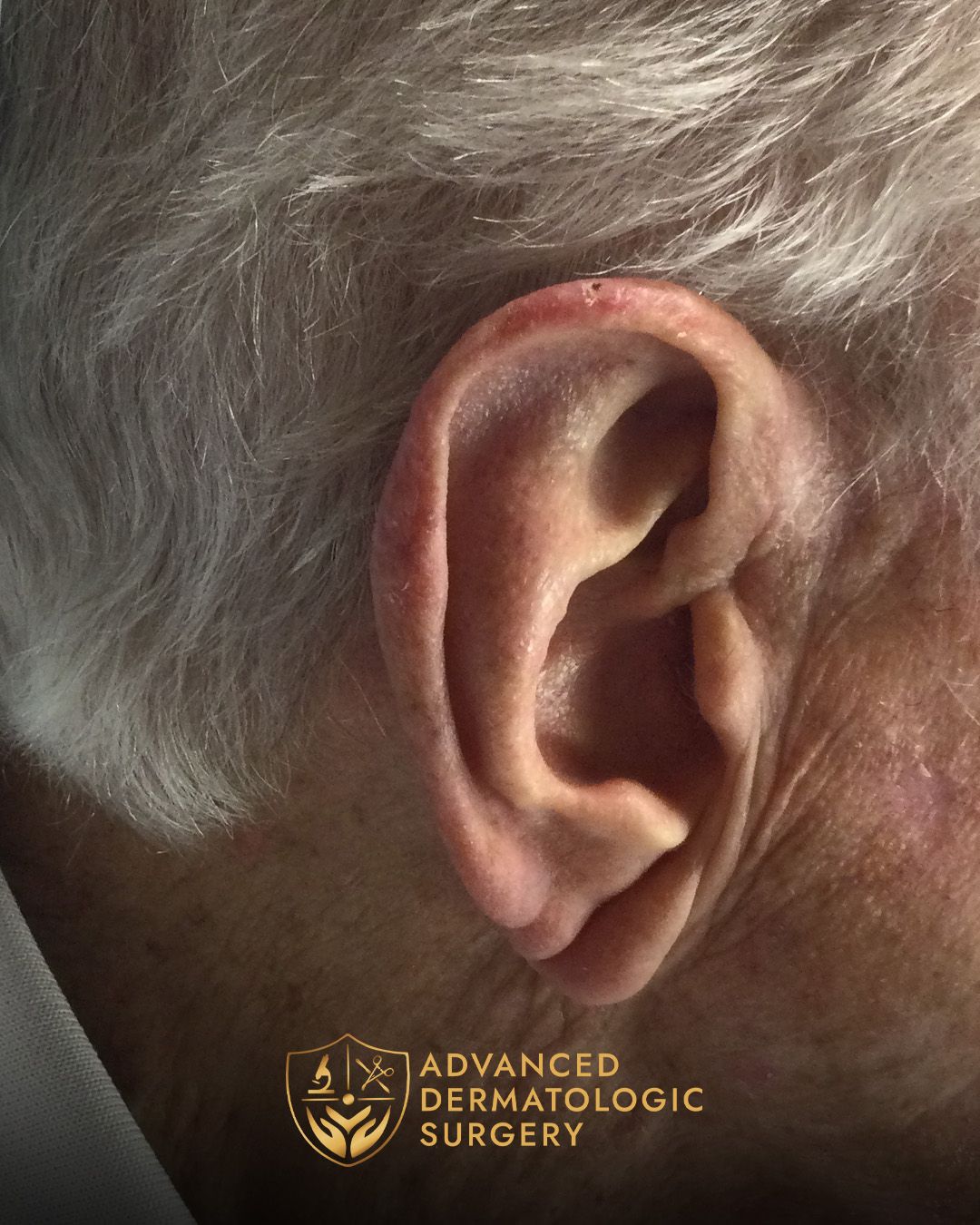 Close up of a man's ear after healing