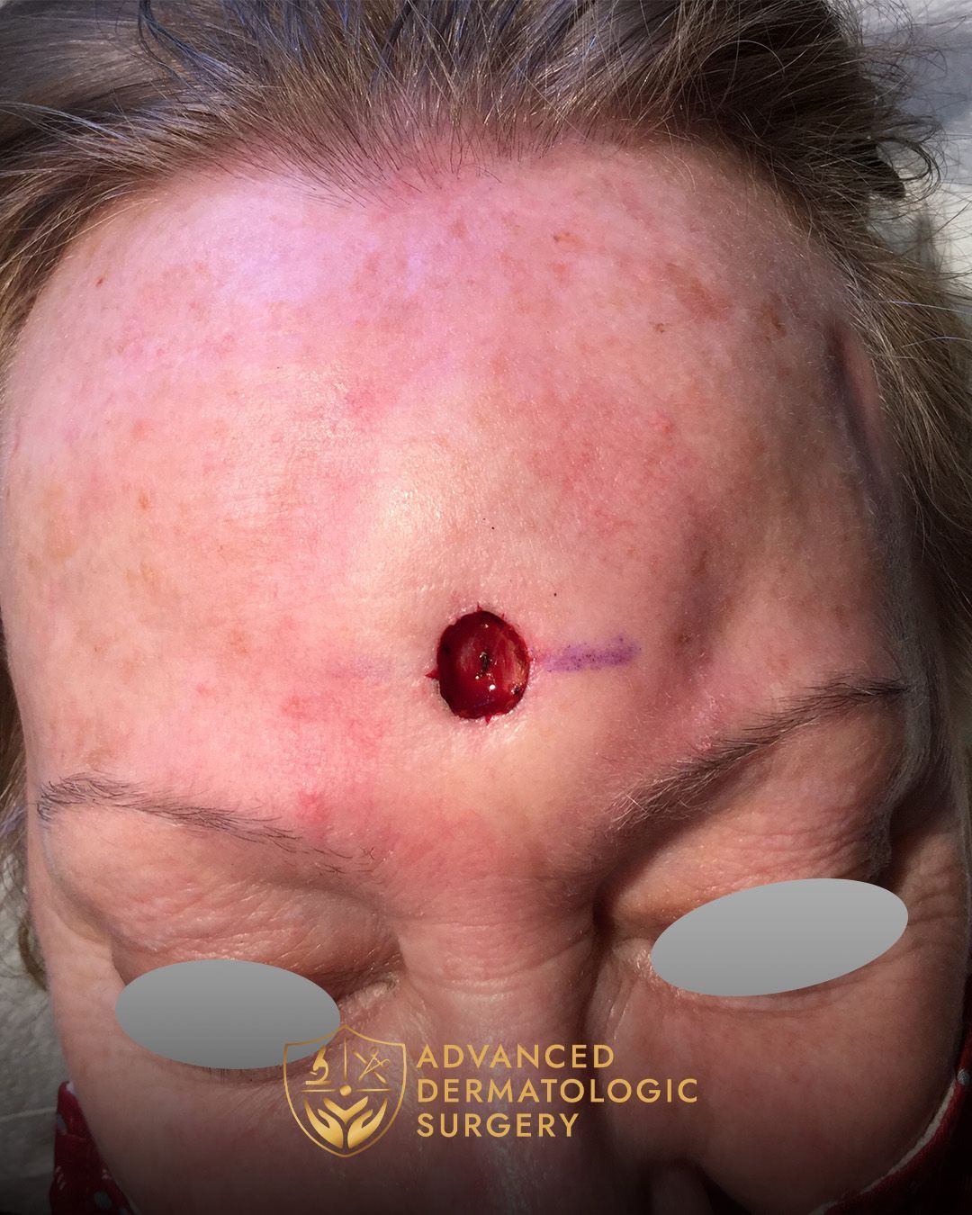 A woman underwent Mohs on her forehead 