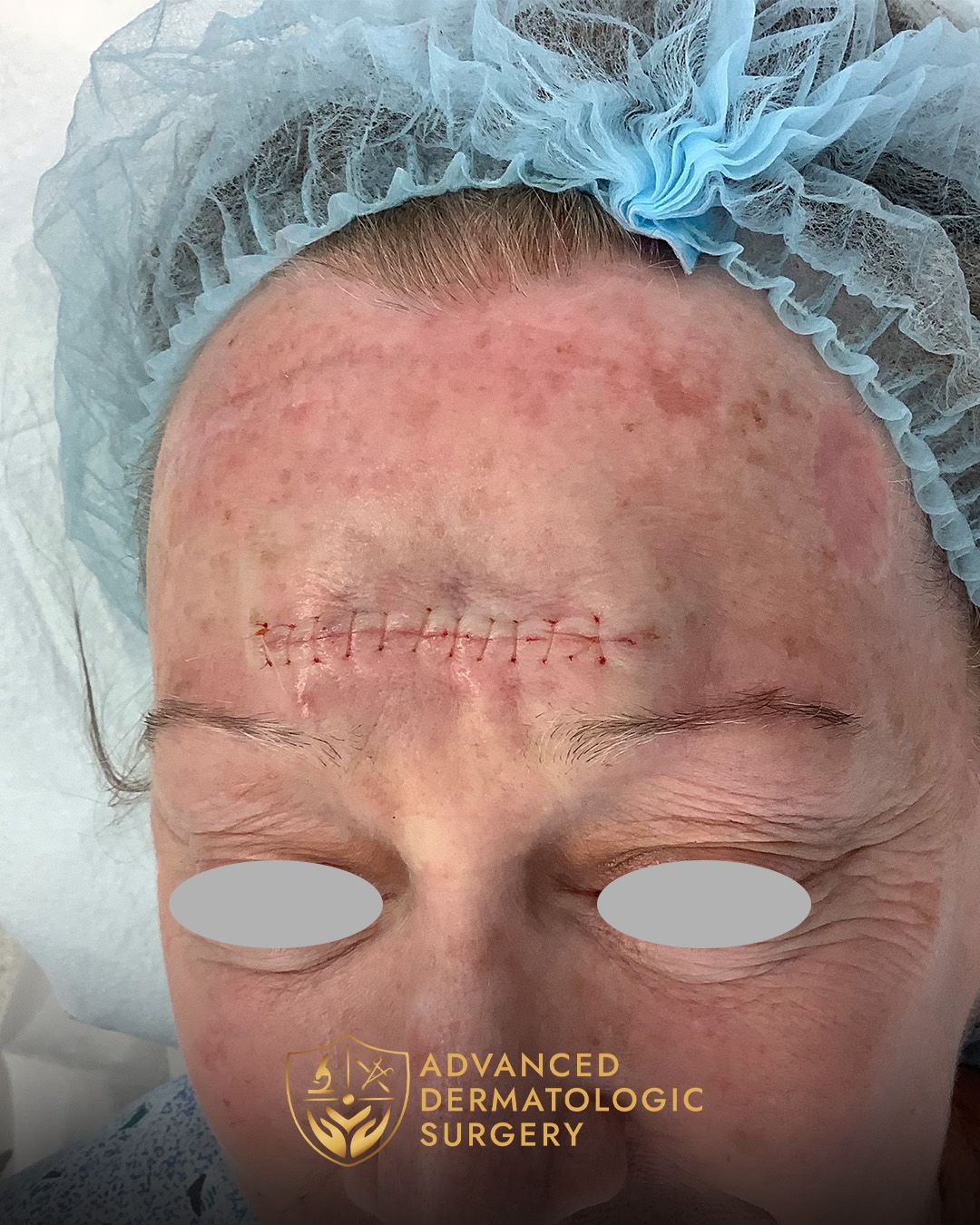Reconstruction surgery on a woman's forehead
