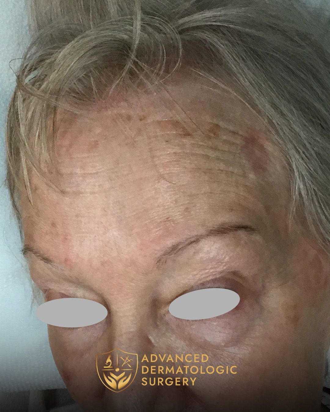 A fully healed forehead surgery on a woman's face