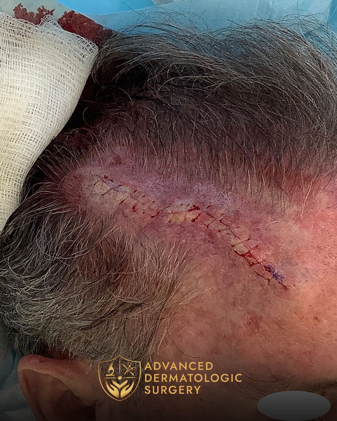 Close up of a reconstruction surgery on a scalp at Advanced Dermatologic Surgery