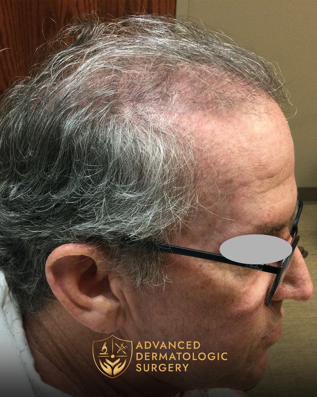 Close up of a fully healed scalp at Advanced Dermatologic Surgery