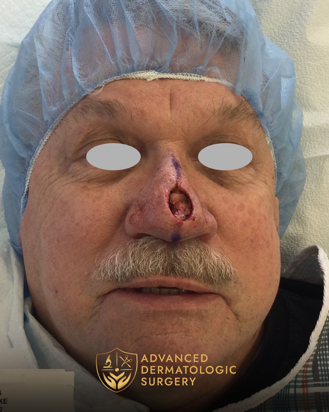 Front view of a man's face after having MOHS surgery on his nose