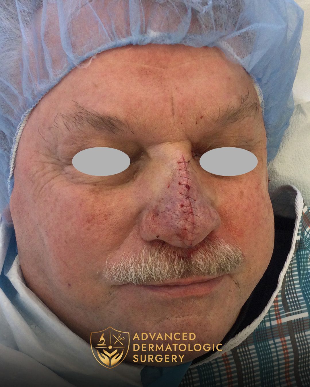Front view of a man's face after having reconstruction surgery on his nose at Advanced Dermatologic Surgery