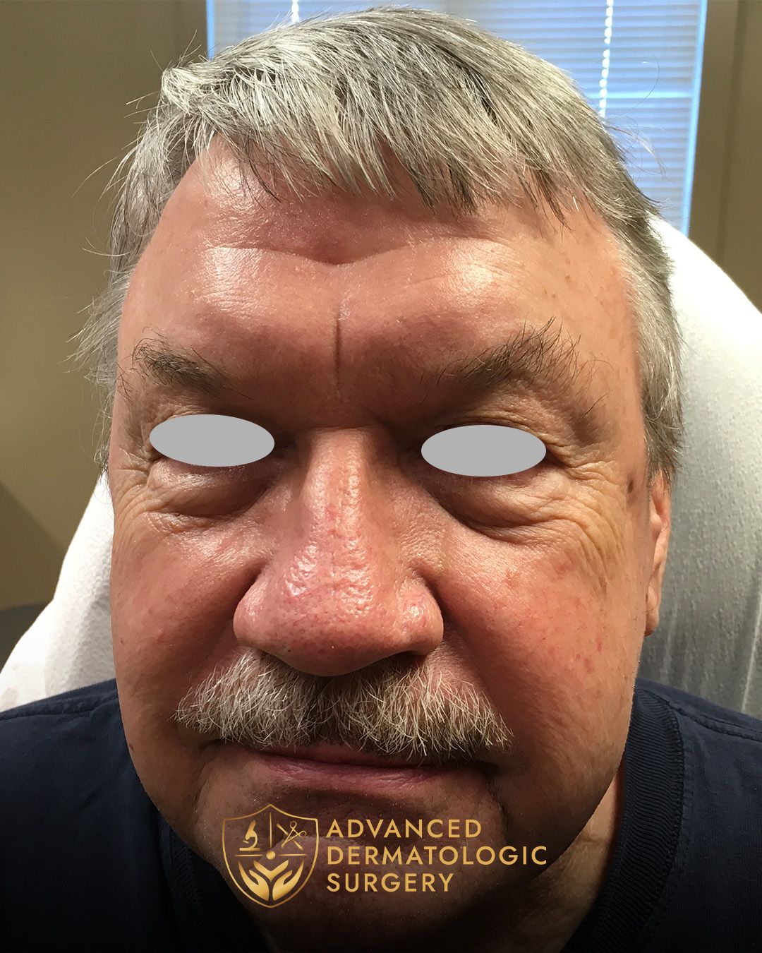A close up of a man's face with a fully healed nose after undergoing surgery at Advanced Dermatologic Surgery