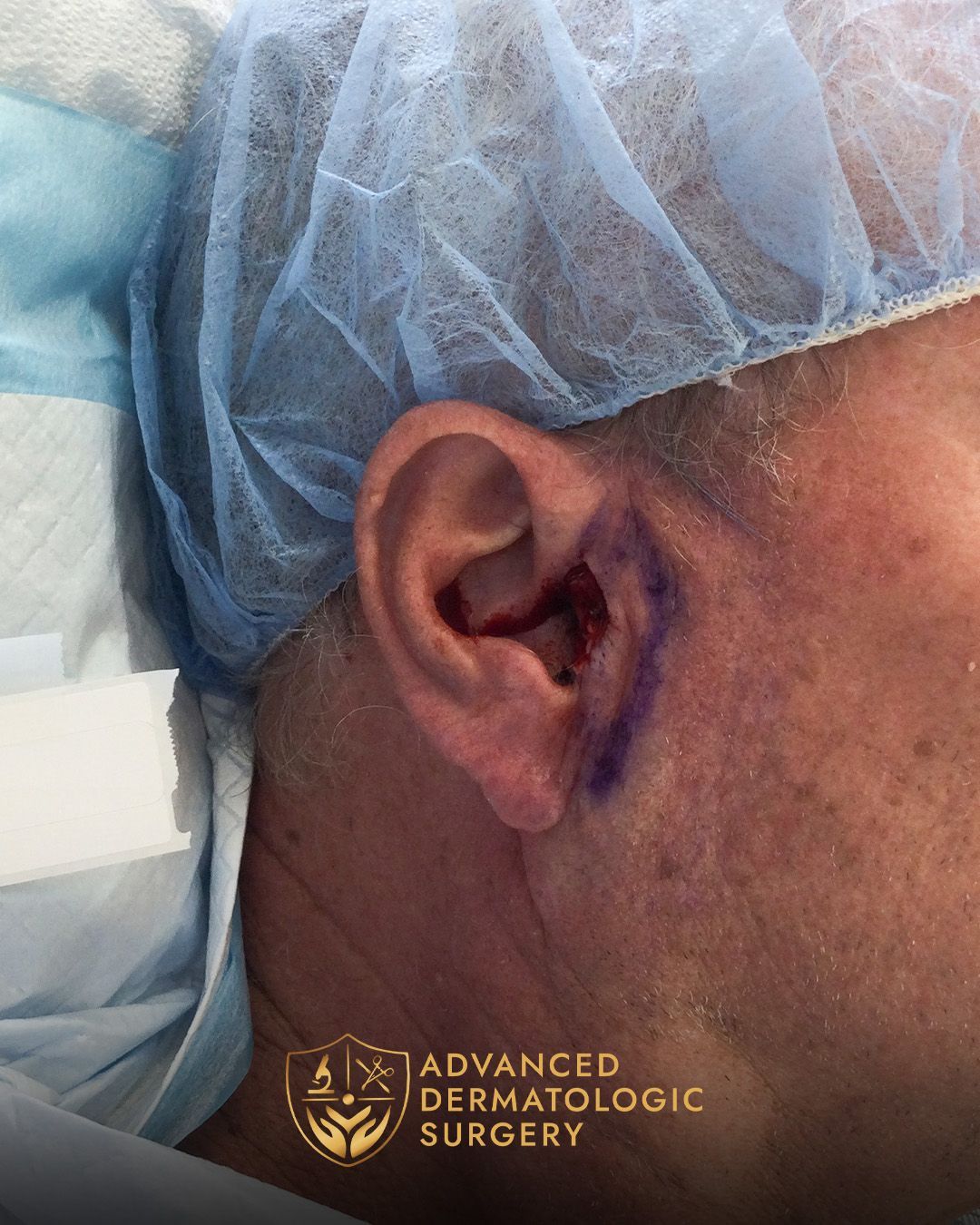 Close up of a spot Mohs removal by a man's ear done at Advanced Dermatologic Surgery