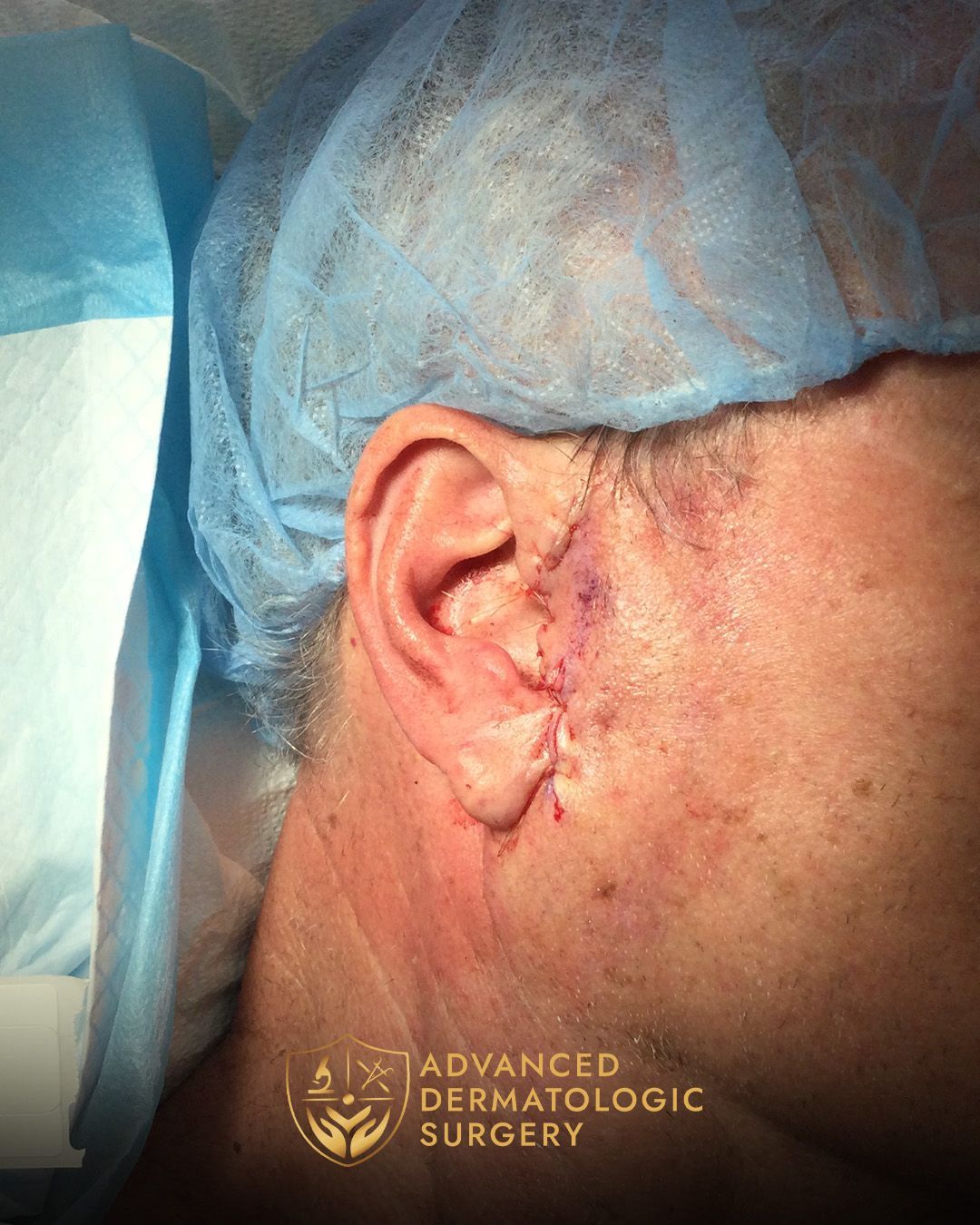 Close up of a man's ear after reconstruction surgery at Advanced Dermatologic Surgery