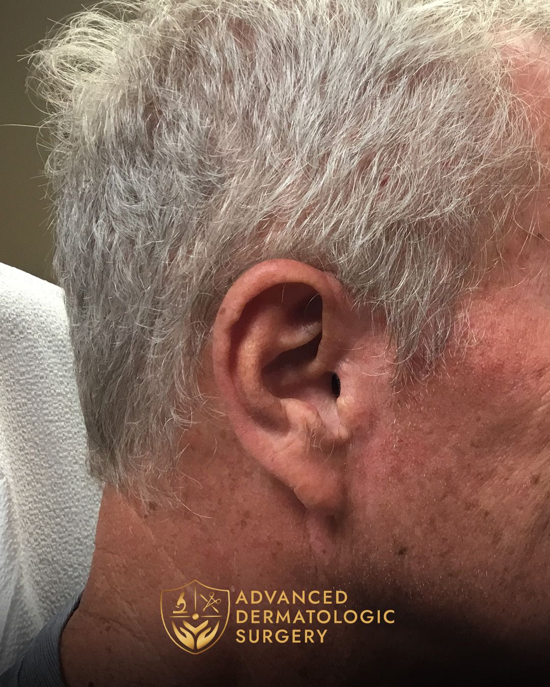 Close up of a man's ear after healing