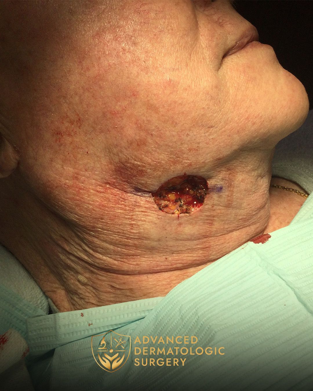 Close up of a mans jawline after receiving Mohs surgery at Advanced Dermatologic Surgery