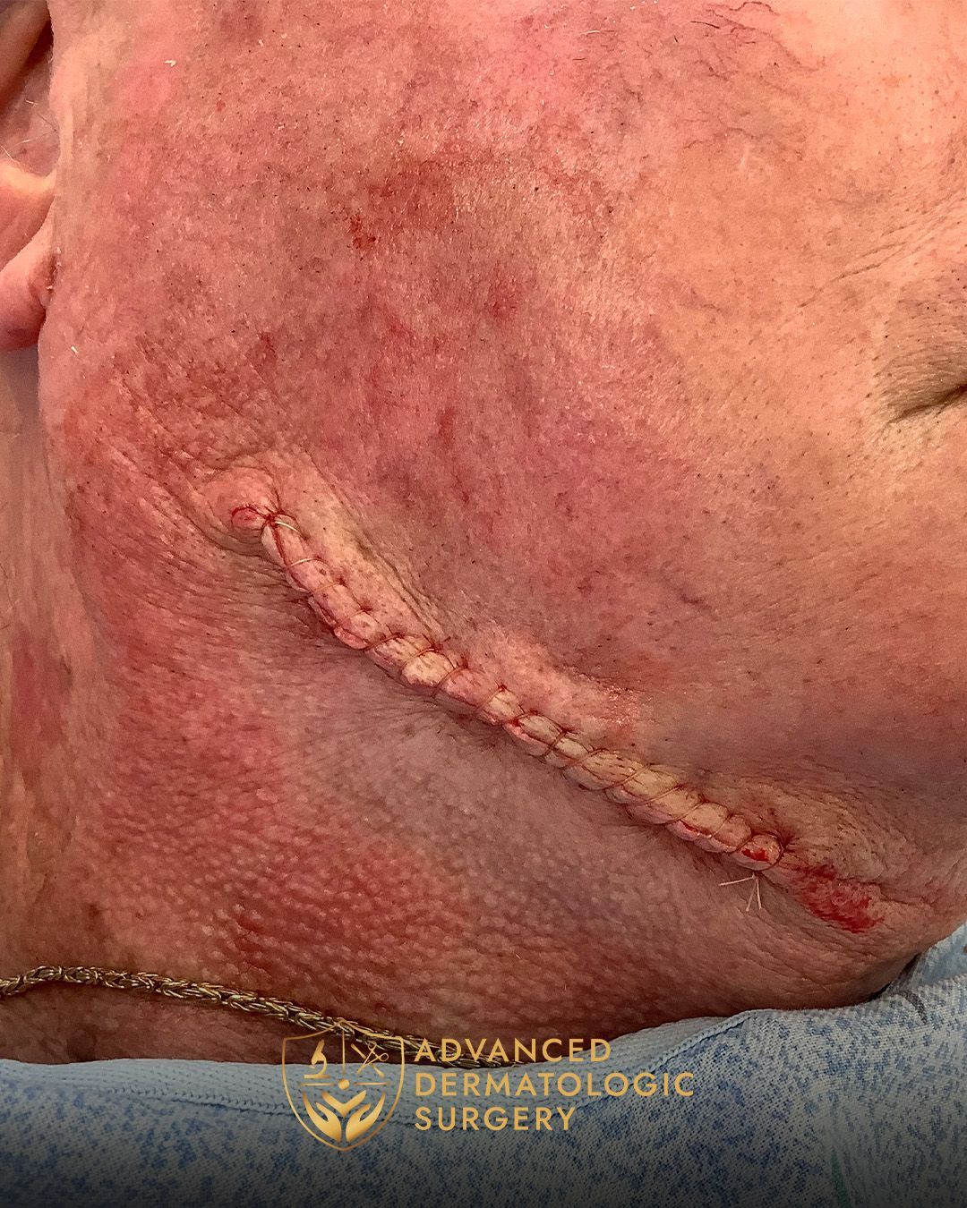 Close up of a mans jawline after reconstruction surgery at Advanced Dermatologic Surgery
