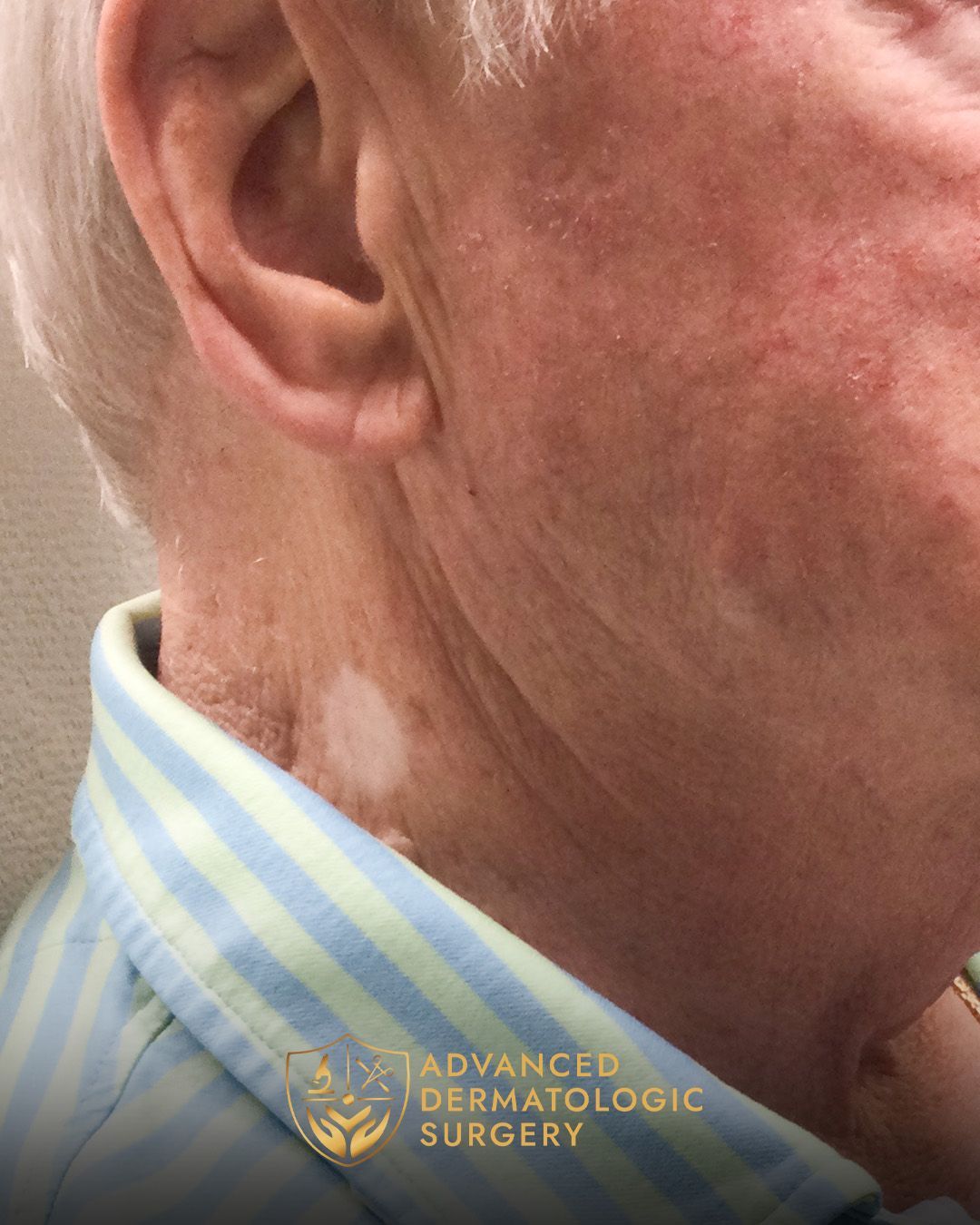 Close up of a fully healed jawline done at Advanced Dermatologic Surgery
