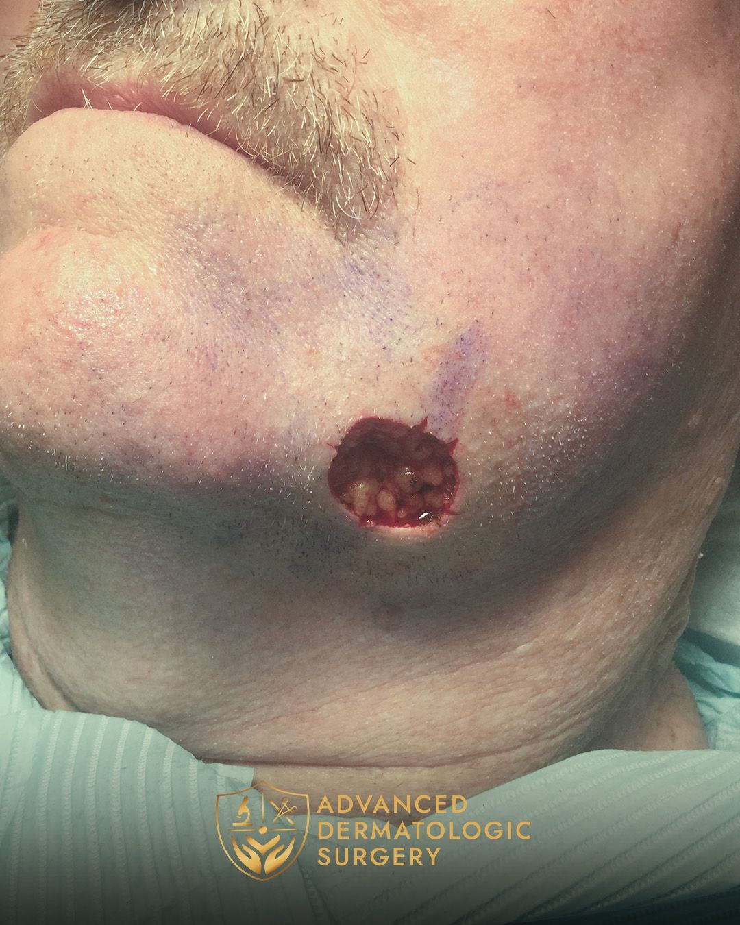 Close up of a mans jawline after receiving Mohs surgery