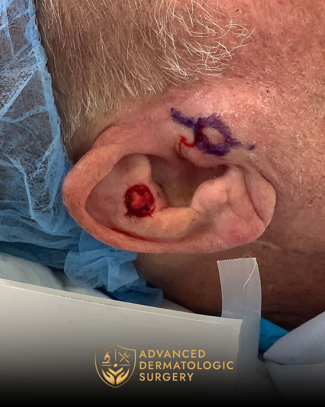 Close up of a pre operative surgery on a man's ear for Mohs surgery at Advanced Dermatologic Surgery