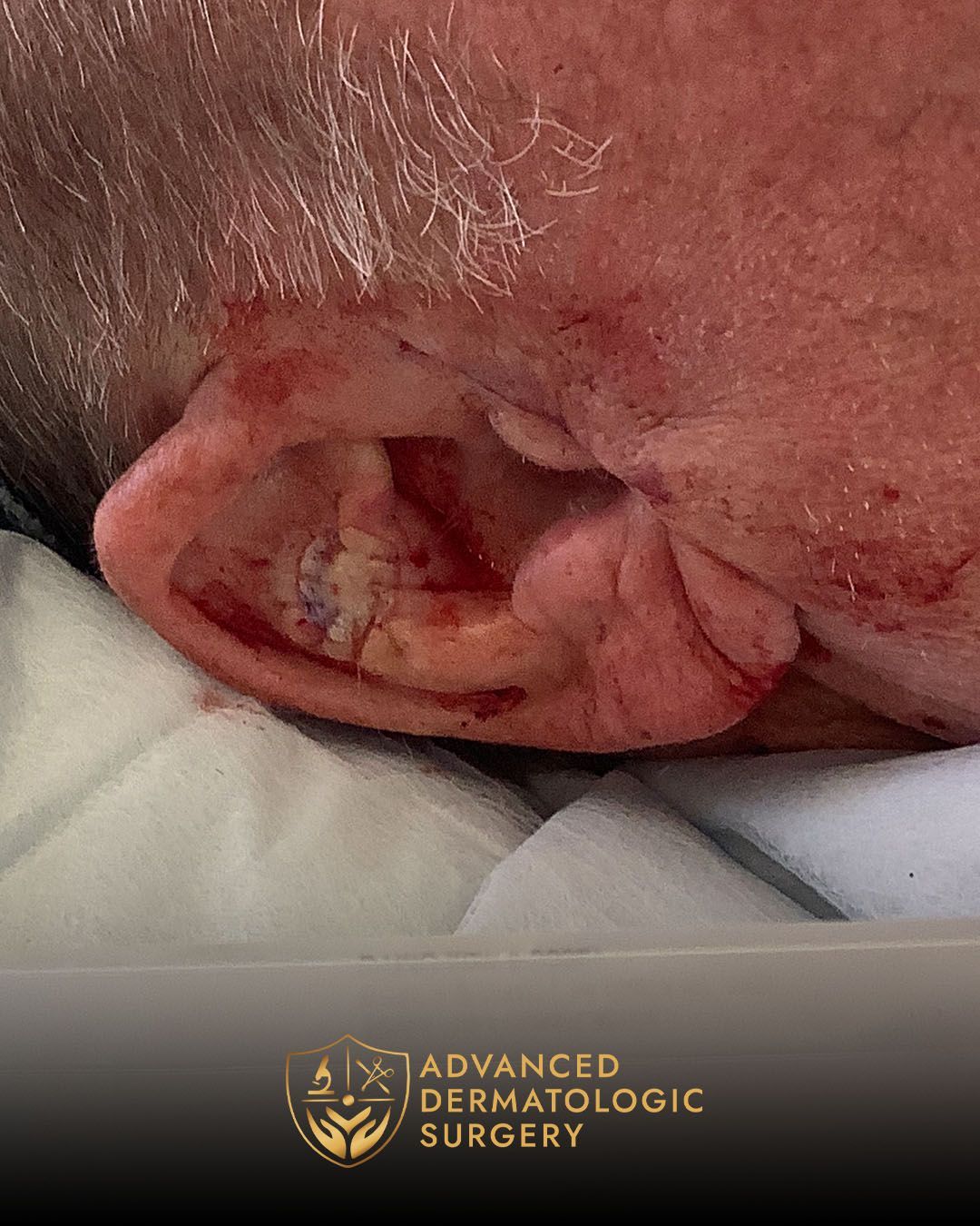 Close up of a post operative surgery on a man's ear for Mohs surgery at Advanced Dermatologic Surgery