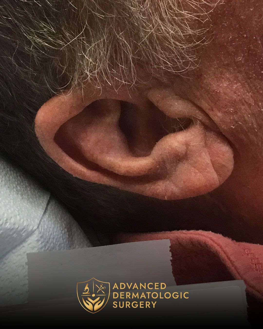 Close up of long term results on a man's ear after Mohs surgery at Advanced Dermatologic Surgery