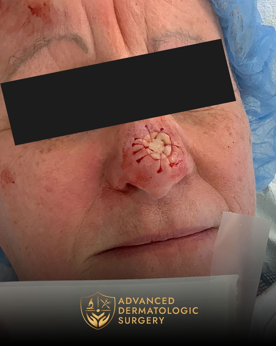 Reconstruction after Mohs surgery at Mohs surgery at Advanced Dermatologic Surgery