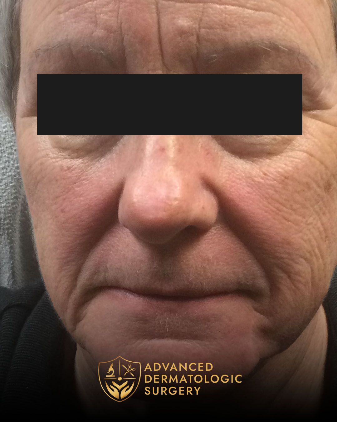 Long-term results from Mohs and Reconstructive surgery at Advanced Dermatologic Surgery