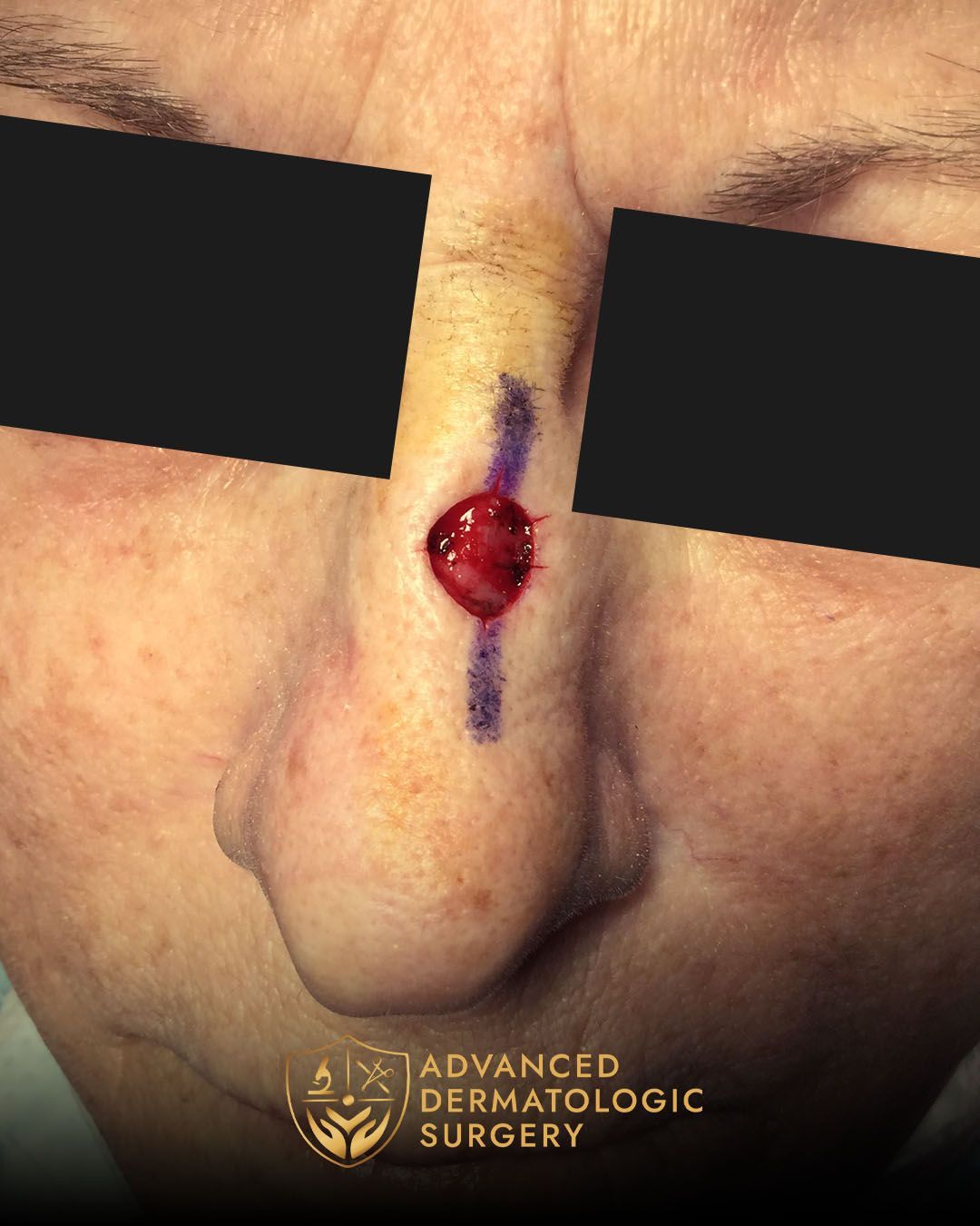 Mohs surgery on nose at dvanced Dermatologic Surgery