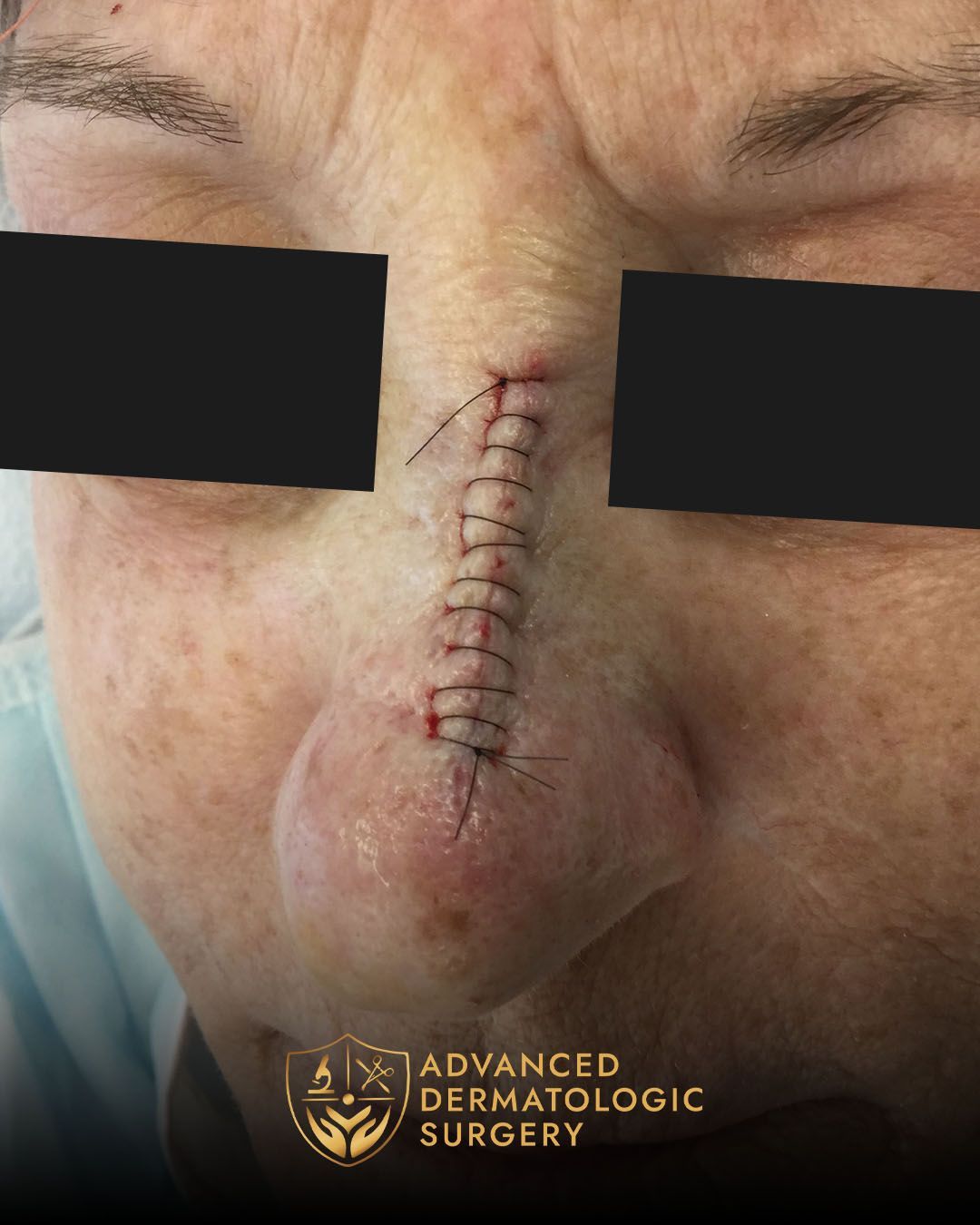 Reconstructive surgery after Mohs surger at dvanced Dermatologic Surgery