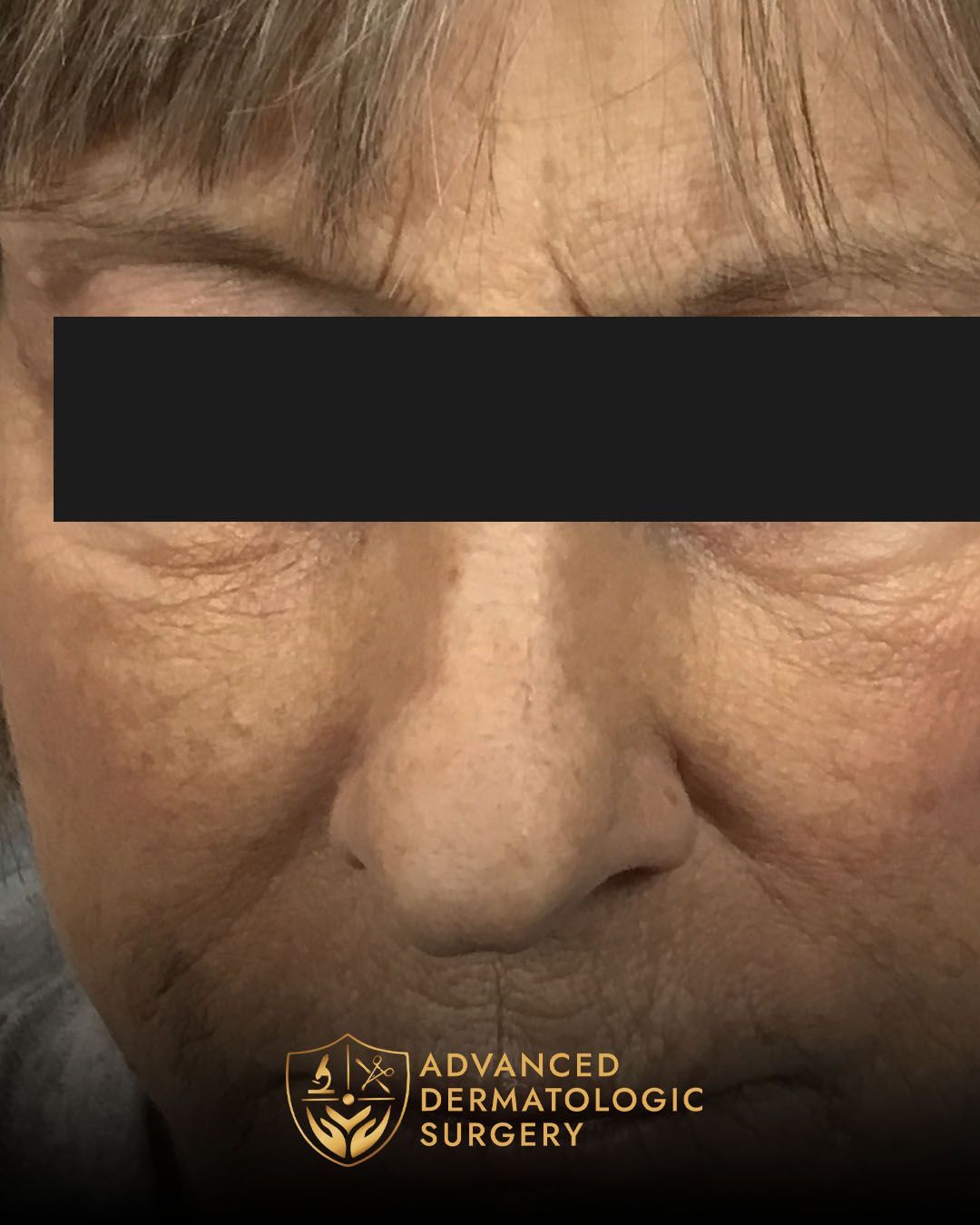 Long-term results of Mohs and Reconstructive surgery at dvanced Dermatologic Surgery