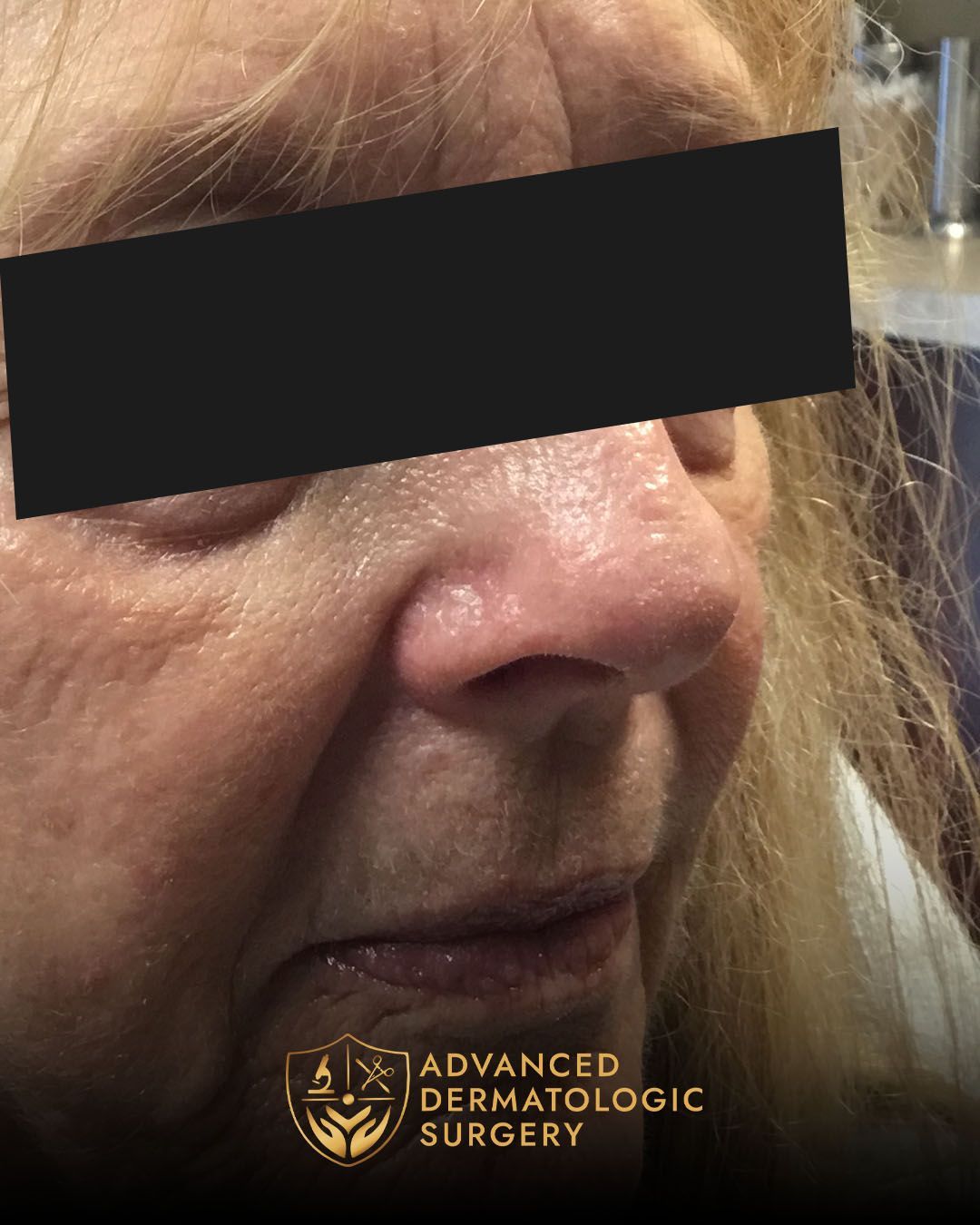 Long-term results of Mohs surgery and Reconstruction on the nose at Advanced Dermatologic Surgery